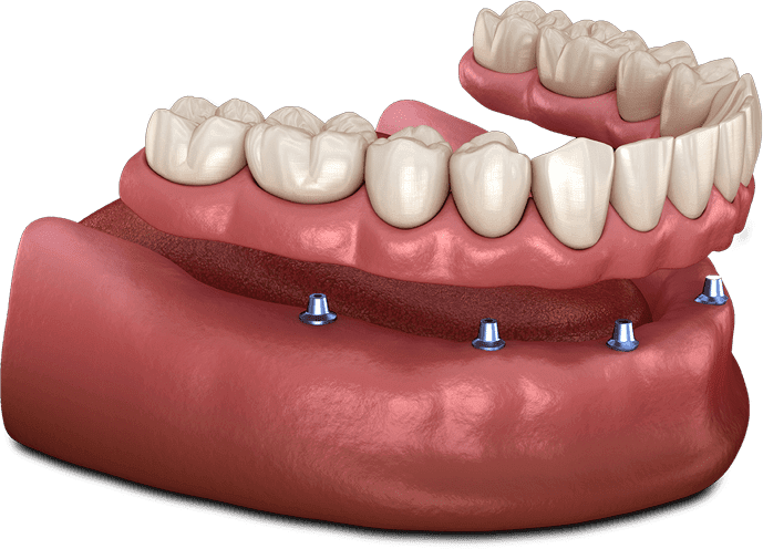 implant supported dentures model