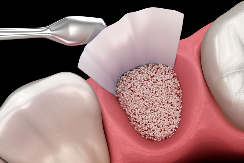 3d render of dental bone grafting procedure