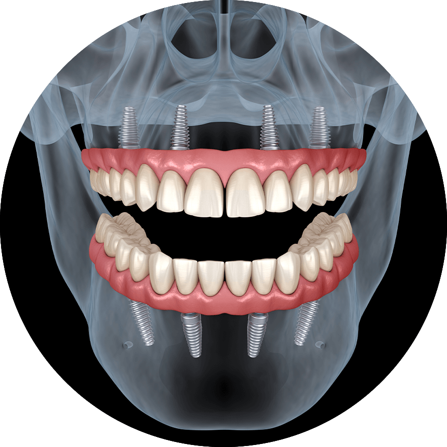 full mouth dental implants