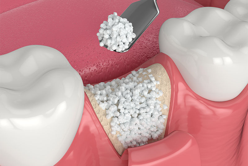 bone graft procedure 3d model