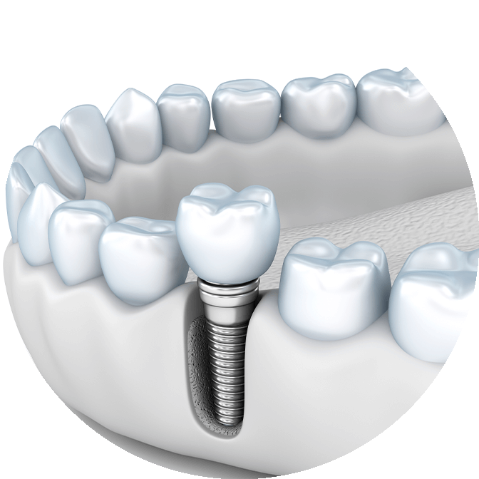 dental implant 3d model
