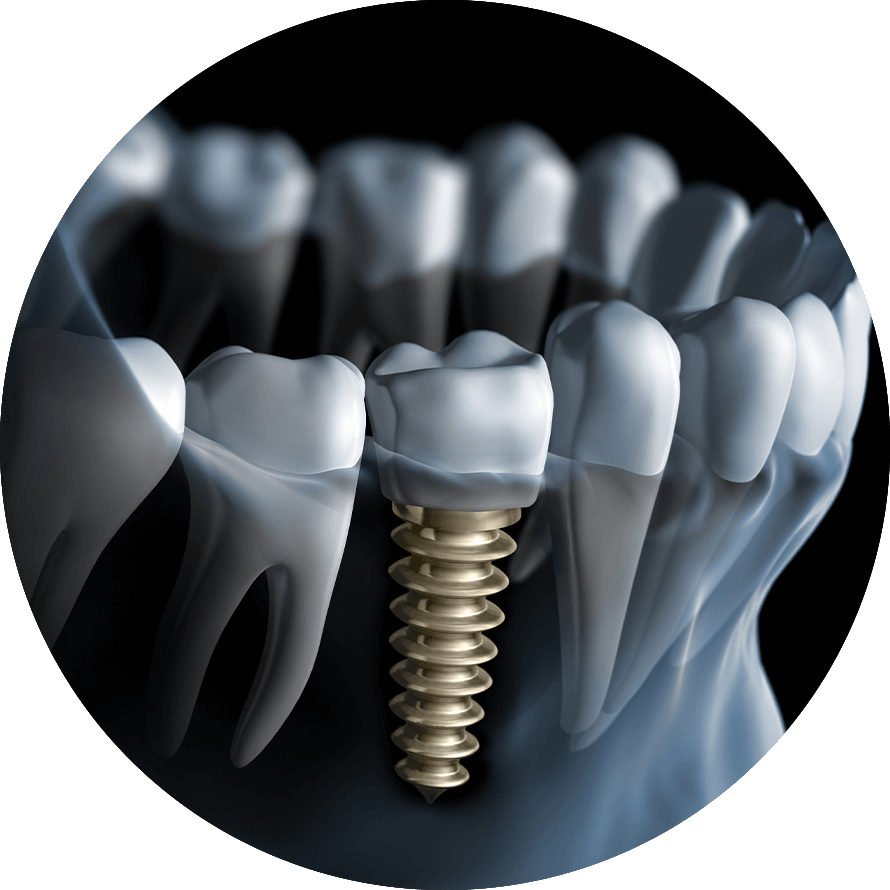 single dental implants