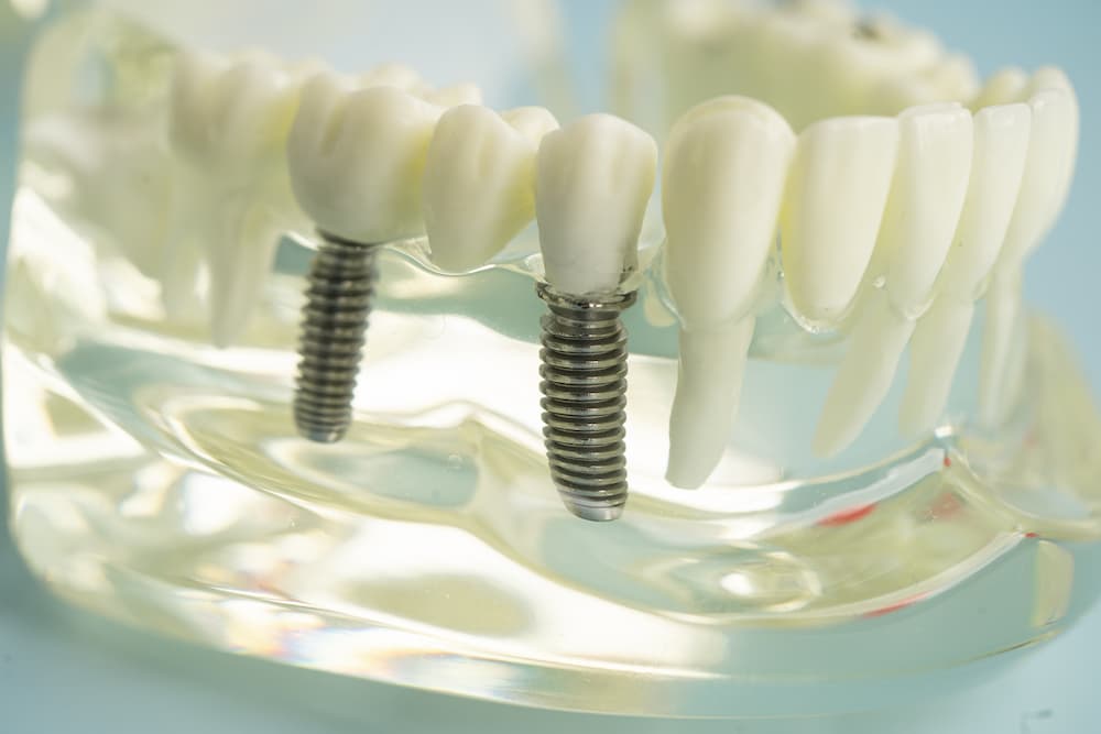 Close-up of a dental demonstration model showing two finished dental implants and crowns screwed into the jawbone, illustrating the implant procedure.