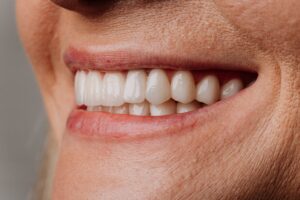 Close-up of a patient’s bright white smile, highlighting professional teeth whitening results.