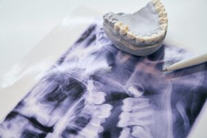 A panoramic dental X-ray film showing the jaw and teeth, with a grey plaster dental mold and a white pen resting on top.